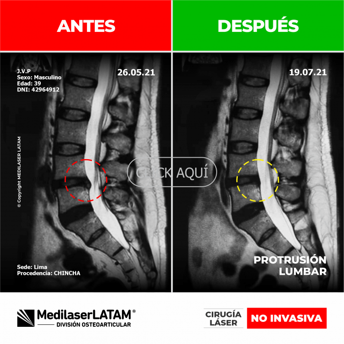 Evidencia en Protrusión Lumbar – Jim Villegas Documentación con TAC que evidencia reabsorción de protrusión discal.
