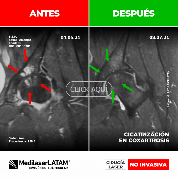Evidencia en Coxartrosis – Sonia Saenz Pruebas imagenológicas que demuestran regeneración en cadera izquierda.