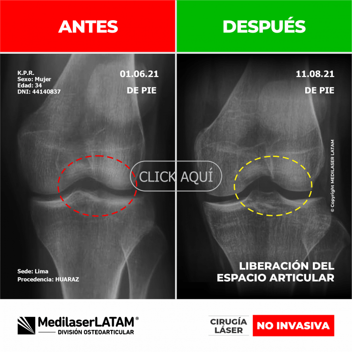 Evidencia en Liberación Articular – Karin Pineda Video testimonio que documenta ampliación del espacio intervertebral L4-L5