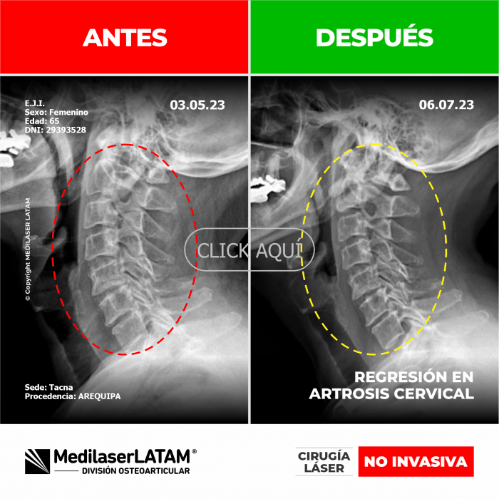 Evidencia en Regresión Cervical – Eleana Jimenez Resonancias que prueban reparación en vértebras cervicales. Caso verificado.