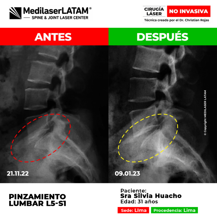 Evidencia en Pinzamiento Lumbar. RM dinámica comprueba liberación de pinzamiento foraminal L3-L4.