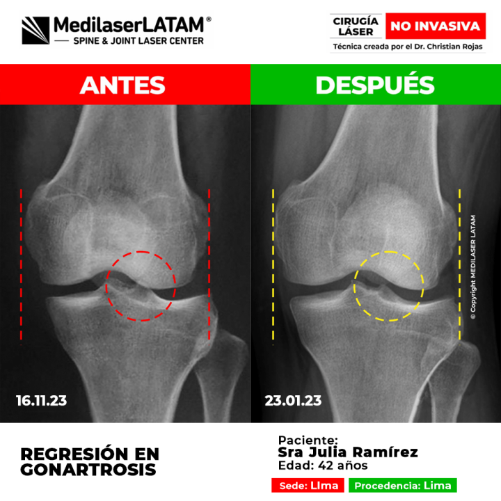 Evidencia de Regresión Gonartrosis. Documentación con pruebas objetivas de mejoría en artrosis bilateral de rodillas.
