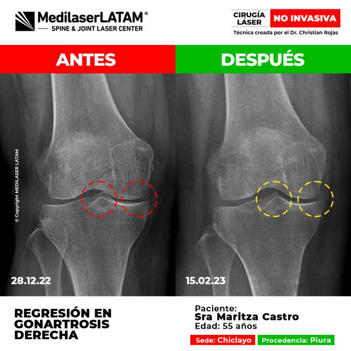 Evidencia en Gonartrosis Derecha. Comparativo radiológico muestra reparación cartilaginosa en rodilla derecha.