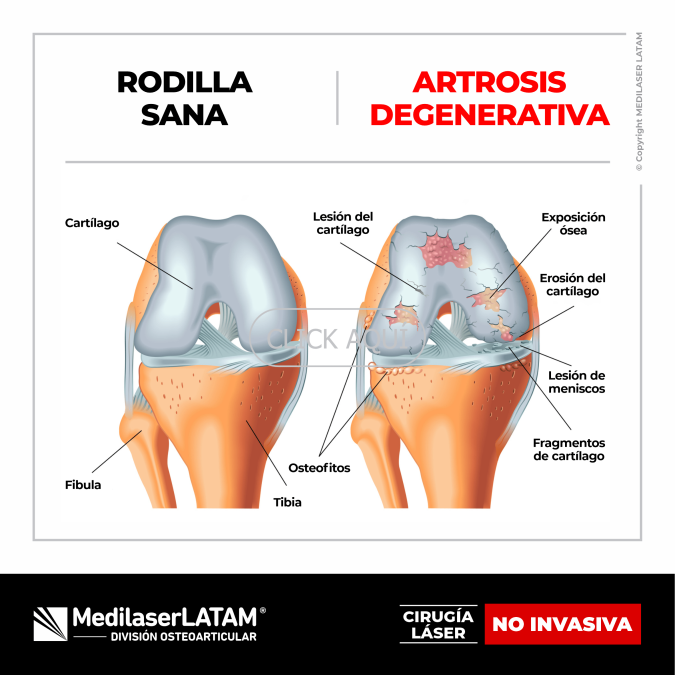 Artrosis degenerativa de rodilla grado 3-4: tratamiento láser para aliviar dolor y recuperar movilidad. 90% efectividad.