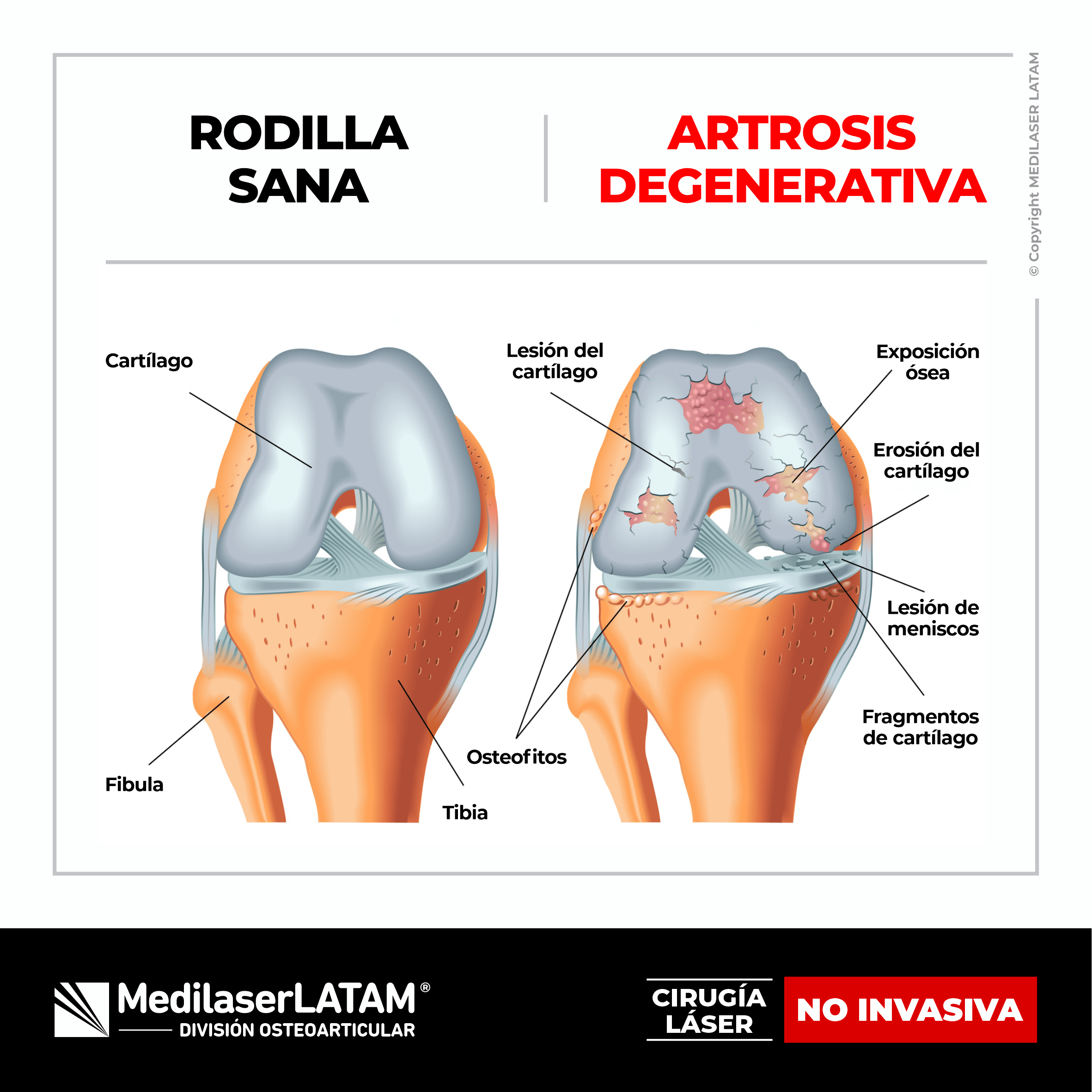 Artrosis degenerativa de rodilla grado 3-4: tratamiento láser para aliviar dolor y recuperar movilidad. 90% efectividad.
