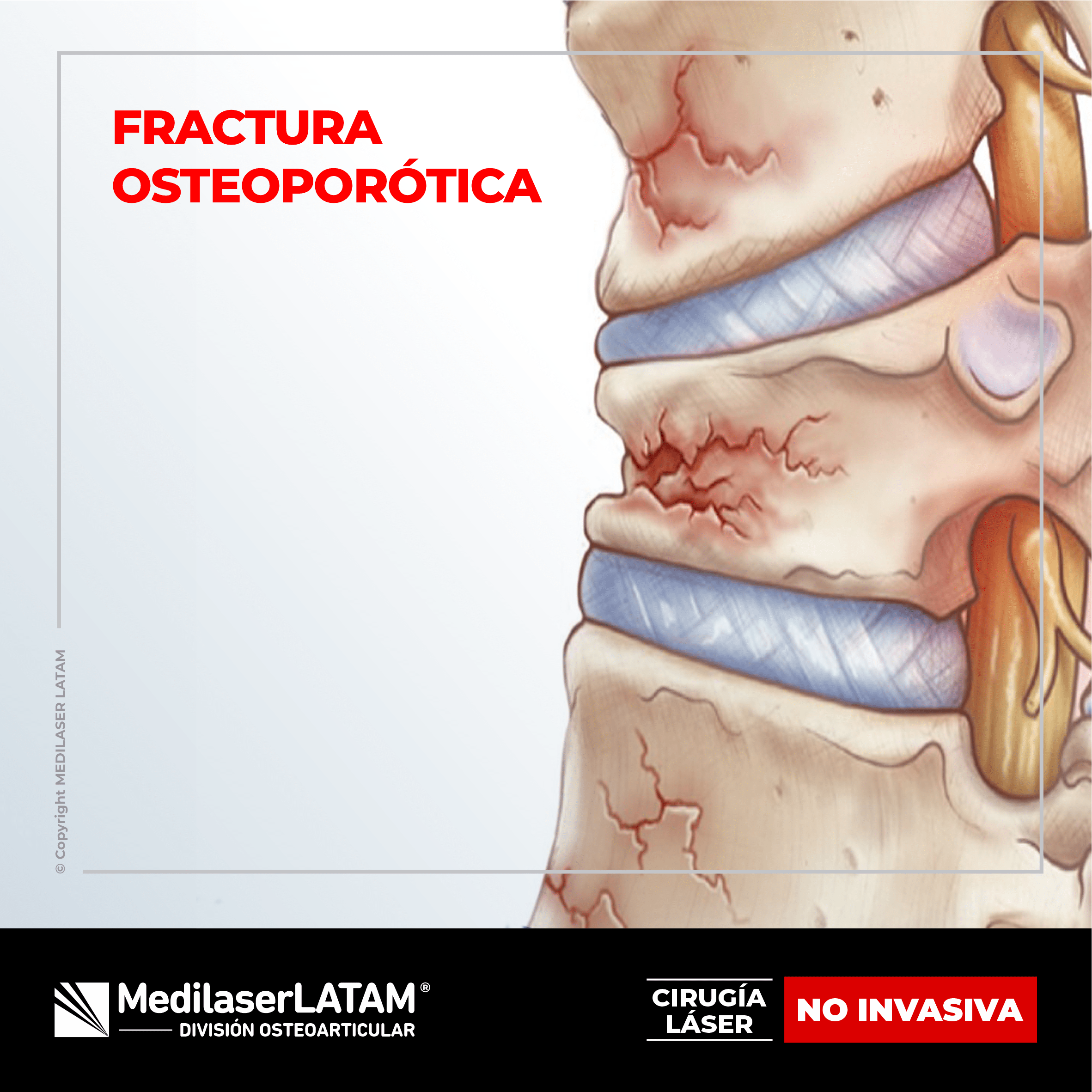 Fractura osteoporótica lumbar: tratamiento láser para consolidación ósea sin cirugía. 90% de efectividad comprobada.