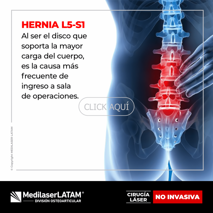 Hernia L5-S1: Tratamiento láser no invasivo que alivia el dolor sin cirugía. Postula para evaluar si eres candidato para una cirugía láser no invasiva en Medilaser LATAM.