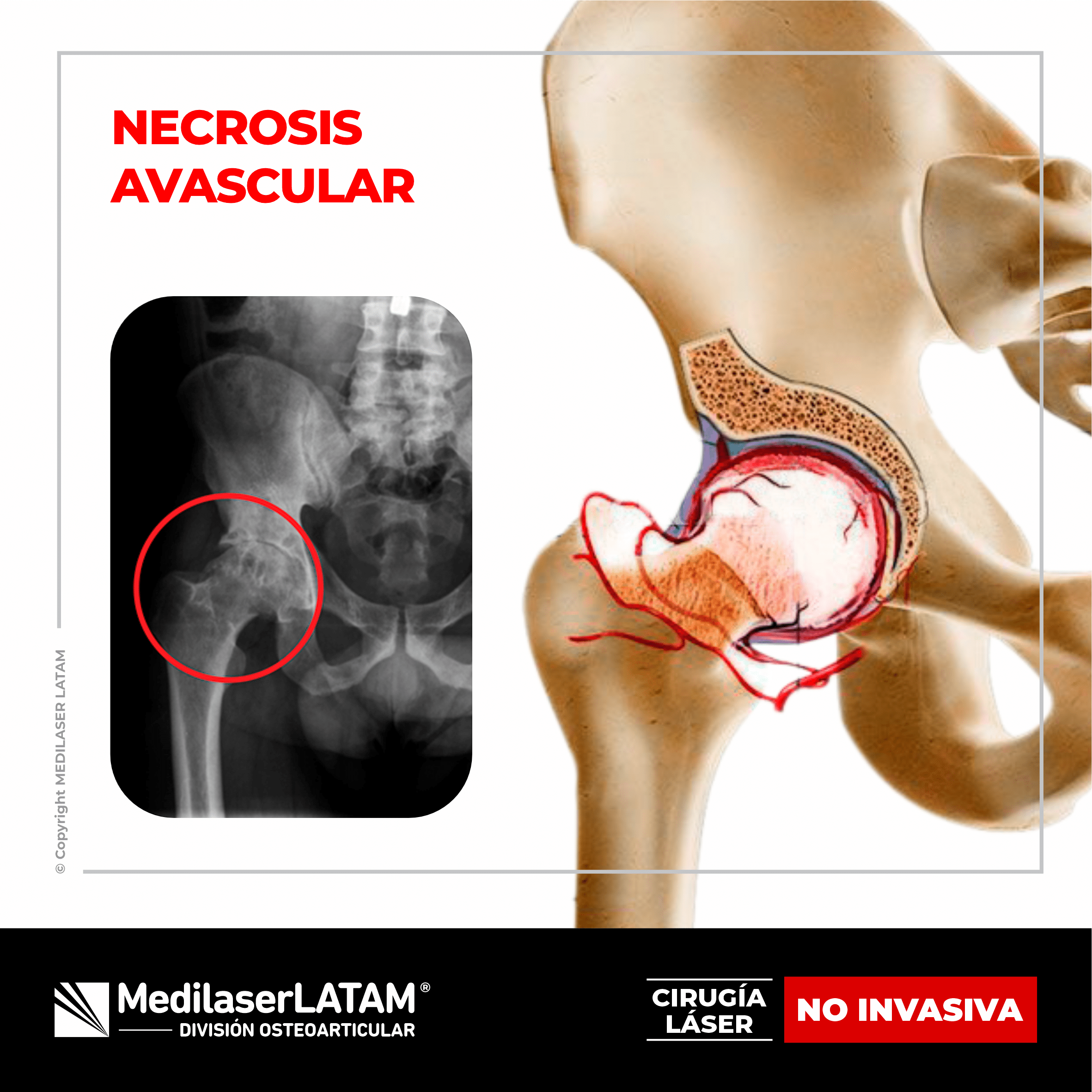 Necrosis avascular de cadera: tratamiento láser regenerativo. 87% de efectividad en casos tempranos. Alternativa a cirugía.