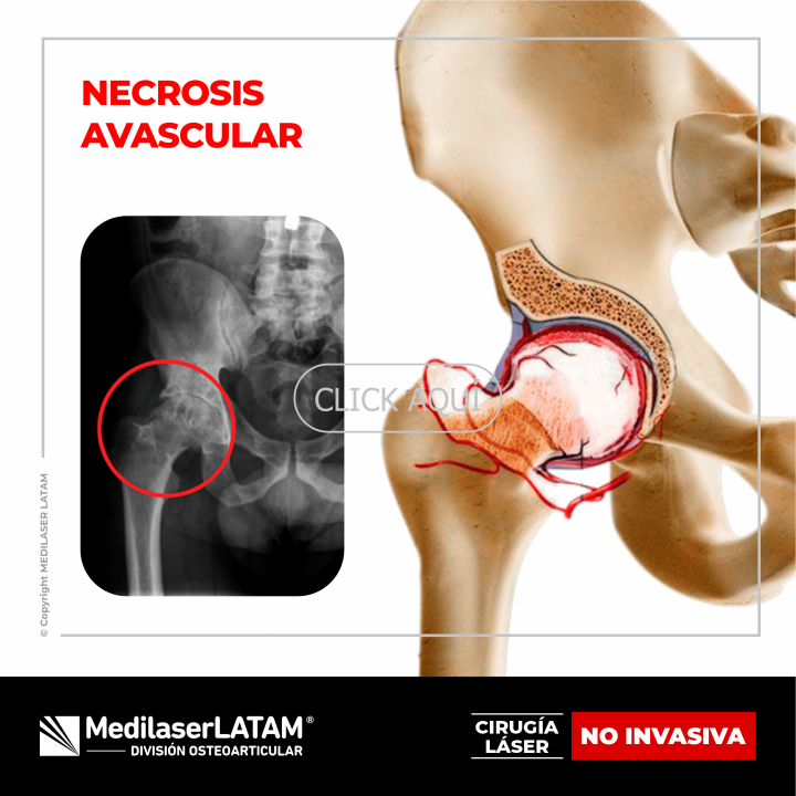Necrosis avascular de cadera: tratamiento láser regenerativo. 87% de efectividad en casos tempranos. Alternativa a cirugía.