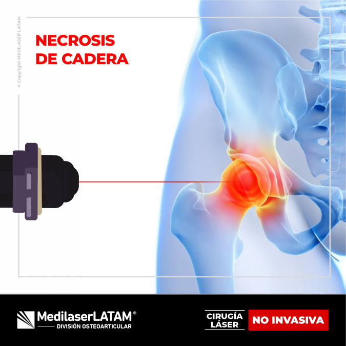 Necrosis de cadera: tratamiento láser regenera hueso sin cirugía. 90% efectividad en casos tempranos. Sin dolor, sin cortes.