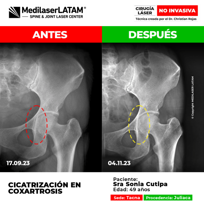 Evidencia en Cicatrización de Coxartrosis. Video testimonial con radiografías que muestran regeneración articular en cadera. Resultados certificados.