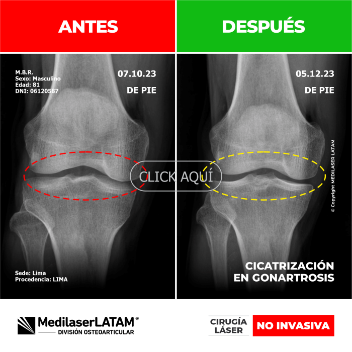 Evidencia en Gonartrosis – Marcos Brito Documentación con imágenes 3D que comprueban reparación cartilaginosa en rodillas.