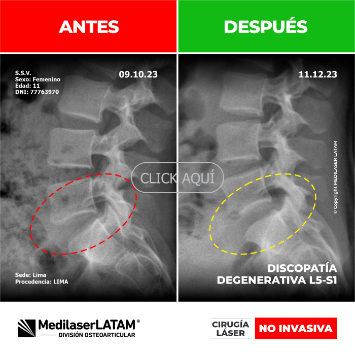 Evidencia en Discopatía L5-S1 – Sacha Silvera Video testimonio con resonancias comparativas que prueban reparación discal.