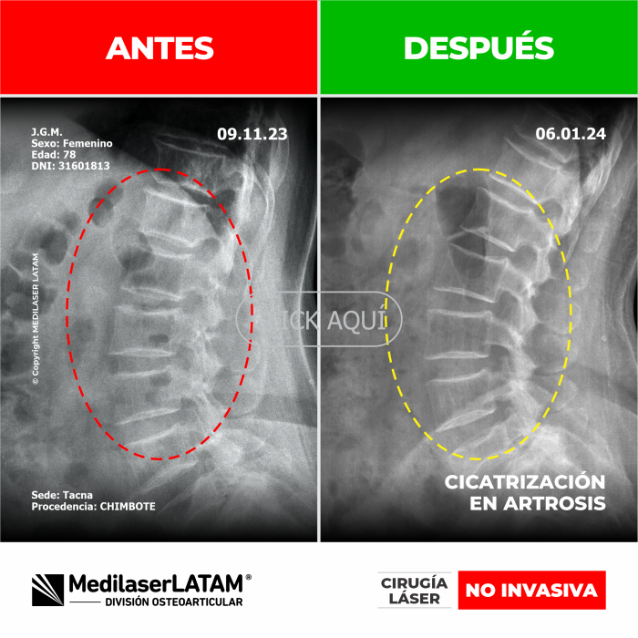 Evidencia en Artrosis – Justina Gamvini Documental clínico con pruebas de reparación articular multifocal. Caso certificado.