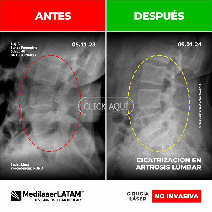 Evidencia en Artrosis Lumbar – Antonieta Quenta Comparativo radiológico que demuestra reparación vertebral sin cirugía invasiva.