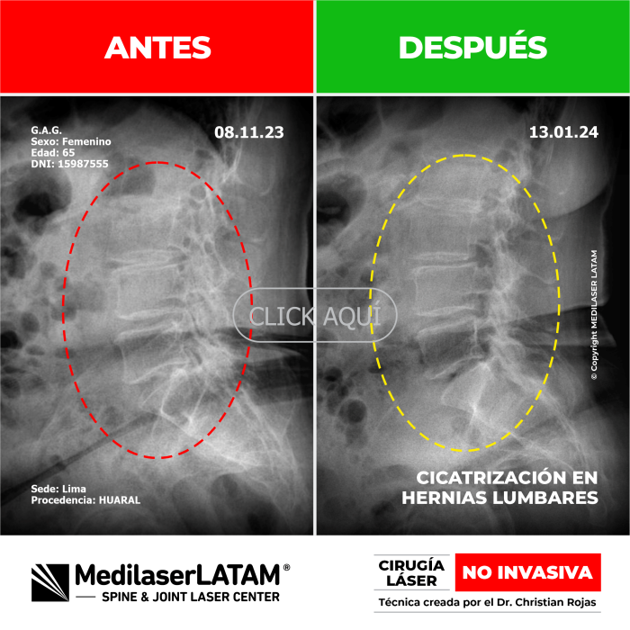 Evidencia en Artrosis Lumbar Severa – Graciela Ayala Secuencia TAC que evidencia reconstrucción ósea en columna degenerativa avanzada.