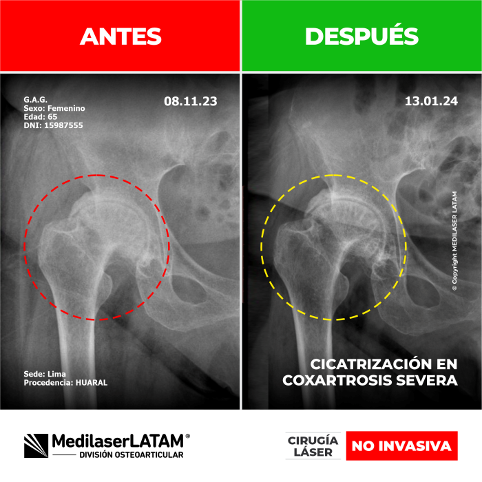 Evidencia en Coxartrosis Severa – Graciela Ayala Video caso con pruebas objetivas de recuperación articular en artrosis de cadera grado IV.