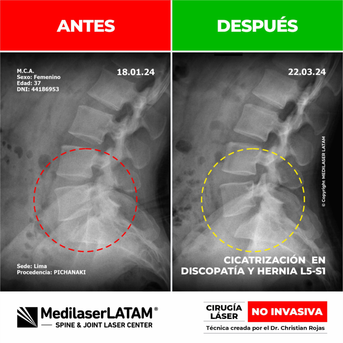 Evidencia en Hernia L5-S1 – Marleny Carhuas Video testimonial con resonancias que muestran reabsorción de hernia discal.