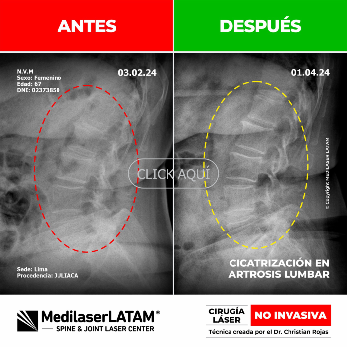 Documental clínico con resonancias que evidencian regeneración articular en artritis juvenil. Caso certificado.