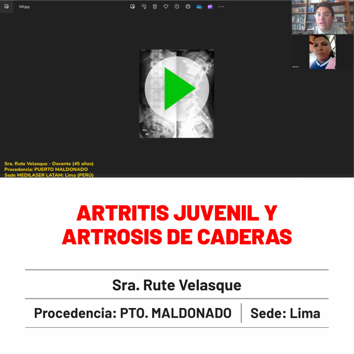 Testimonio de Rute Velasque: "Artritis juvenil y artrosis de caderas mejoradas. Única terapia láser con resultados permanentes.