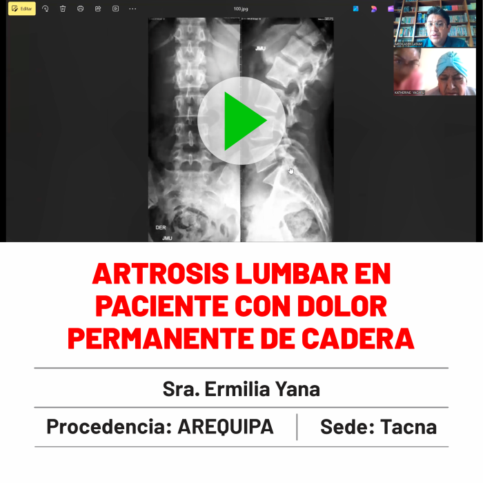 Testimonio de Ermilia Yana: "Artrosis lumbar y dolor de cadera crónico eliminados. Experiencia real de paciente tratada con técnicas avanzadas.
