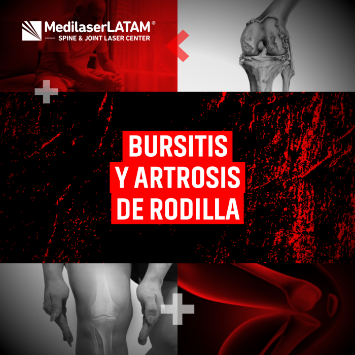 Bursitis + artrosis en rodilla: protocolos para desinflamar y regenerar. Alivio del dolor con técnicas mínimamente invasivas.
