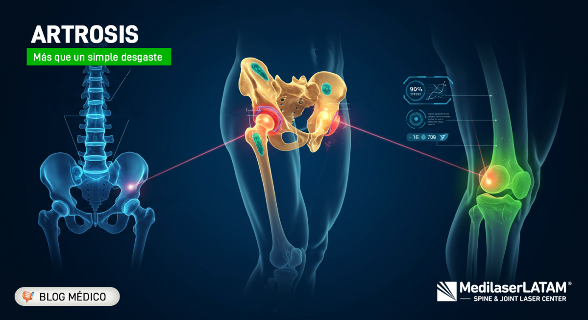 Artrosis: Conoce sus tipos, síntomas y tratamientos con láser. 85% de efectividad comprobada. Evita prótesis y recupera tu movilidad.
