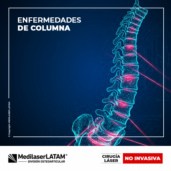 Tratamiento láser para hernias discales y dolor lumbar. Sin incisiones, sin riesgos quirúrgicos. Alta el mismo día y recuperación acelerada.