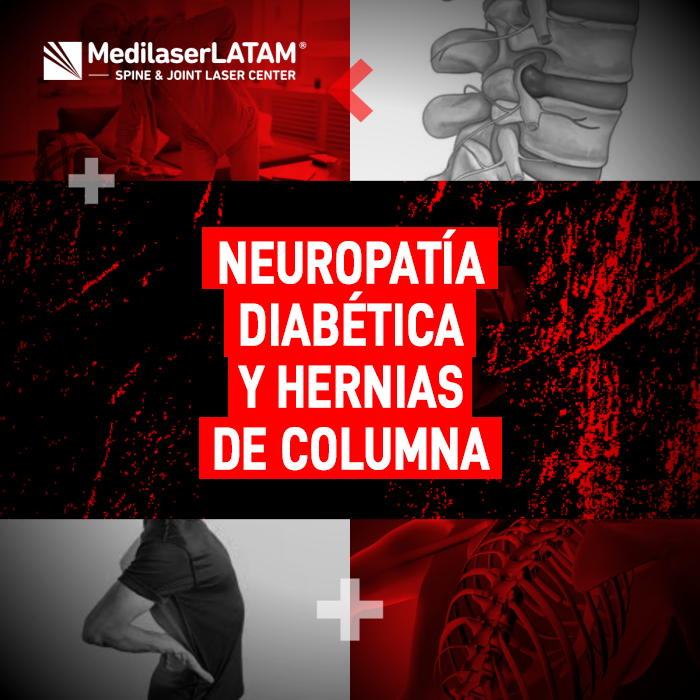Entiende la conexión entre la neuropatía diabética y las hernias de columna. Guía informativa sobre síntomas y la mejor forma de tratarlos.