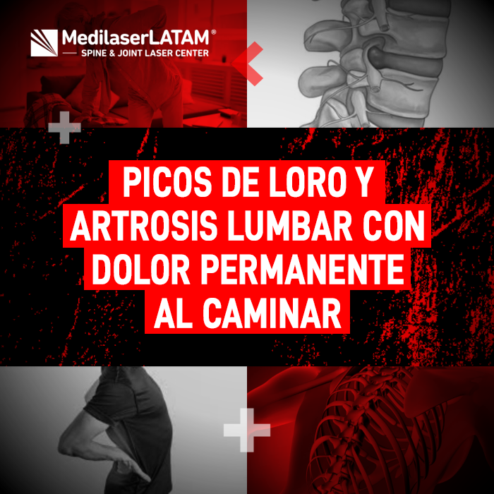 Descubre la relación entre los picos de loro, la artrosis lumbar y el dolor al caminar. Encuentra soluciones para mejorar tu bienestar diario.