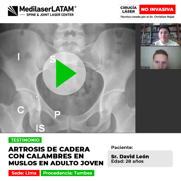 Testimonio de David León: Cirugía láser no invasiva para Artrosis de cadera con calambres en muslos en adulto joven