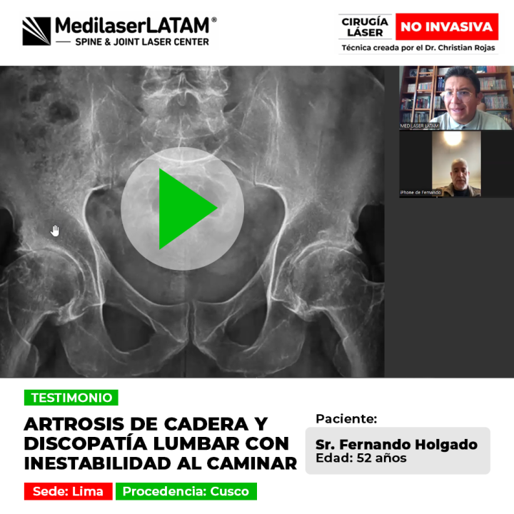 Testimonio de Fernando Holgado: Cirugía láser no invasiva para Artrosis de cadera y discopatía lumbar con inestabilidad al caminar