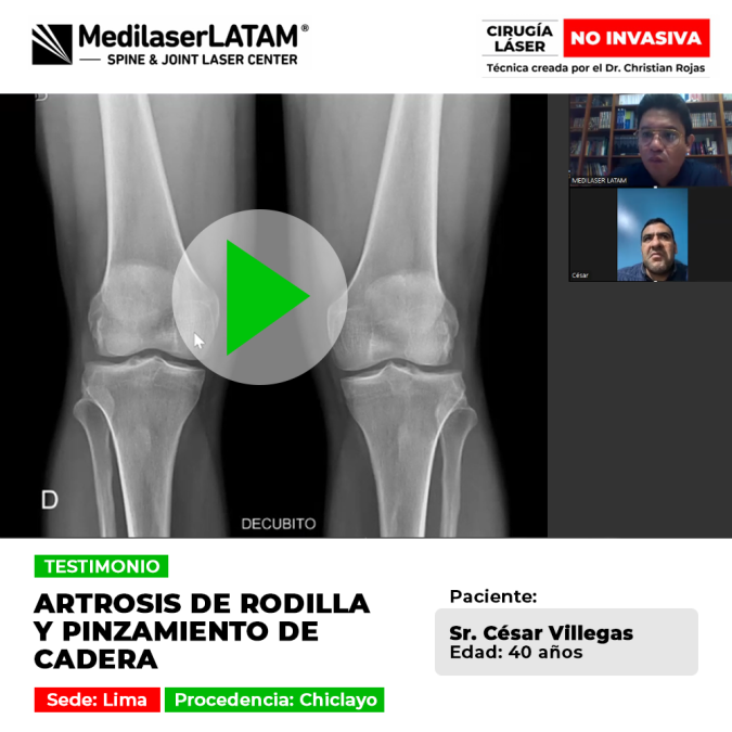 Testimonio de César Villegas: Cirugía láser no invasiva para Artrosis de rodilla y pinzamiento de cadera en paciente joven