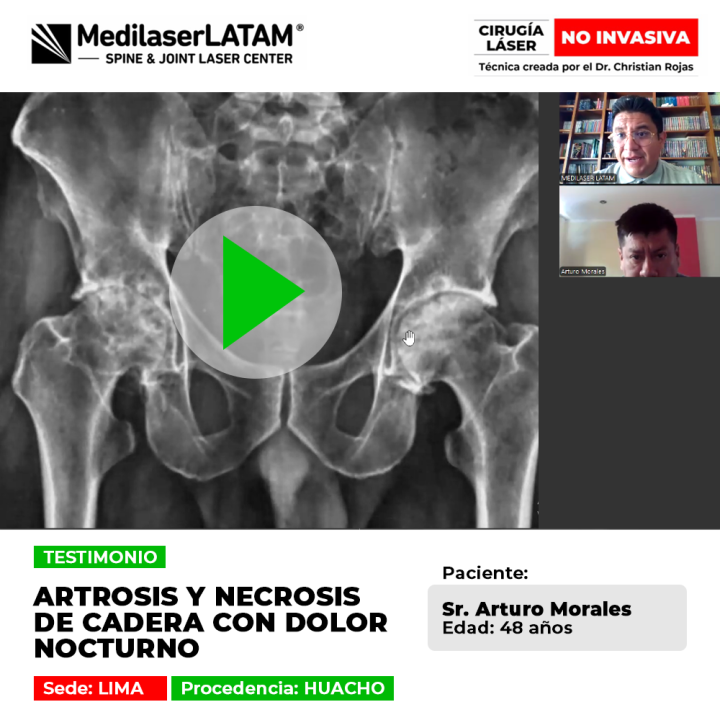 Arturo Morales relata su lucha contra la artrosis y necrosis de cadera, que le causaban dolor nocturno. Se recuperó con tratamiento láser.
