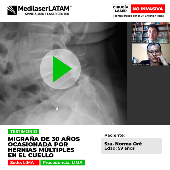 Norma Oré (Lima) padeció migraña crónica de 30 años, causada por hernias en el cuello. Vea cómo la cirugía láser eliminó la raíz de su dolor de cabeza.
