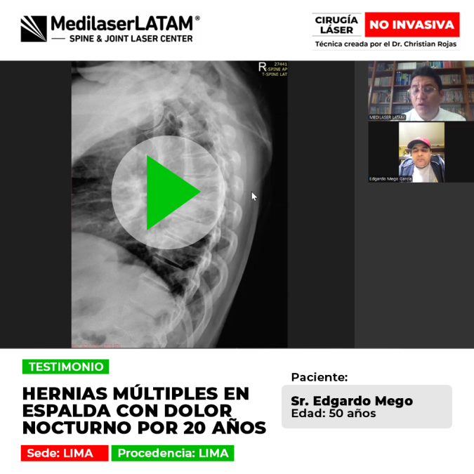 Edgardo Mego (Lima) sufrió hernias múltiples y dolor nocturno por 20 años. Descubra su recuperación total con la innovadora cirugía láser Medilaser.