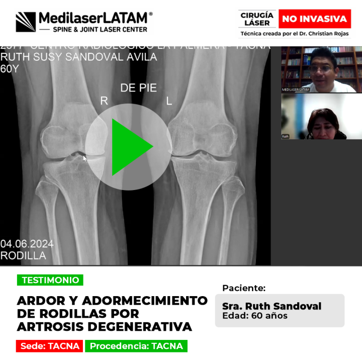 Artrosis rodillas adormecimiento y ardor. Ruth Sandoval (Tacna) comparte cómo superó los síntomas de su artrosis degenerativa con éxito.