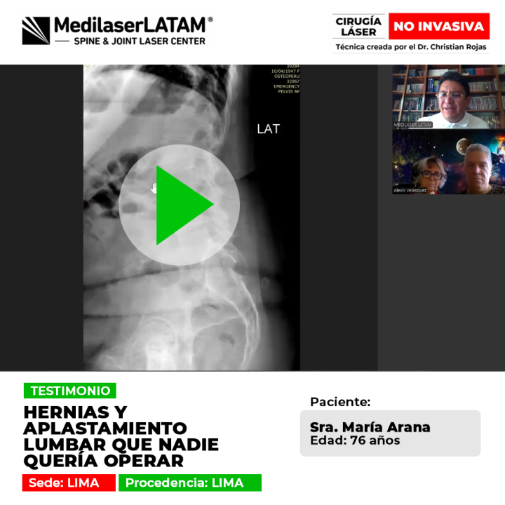 Caso de aplastamiento lumbar con hernias que ningún médico quería tratar. Conoce la cirugía láser que le permitió recuperar su vida.
