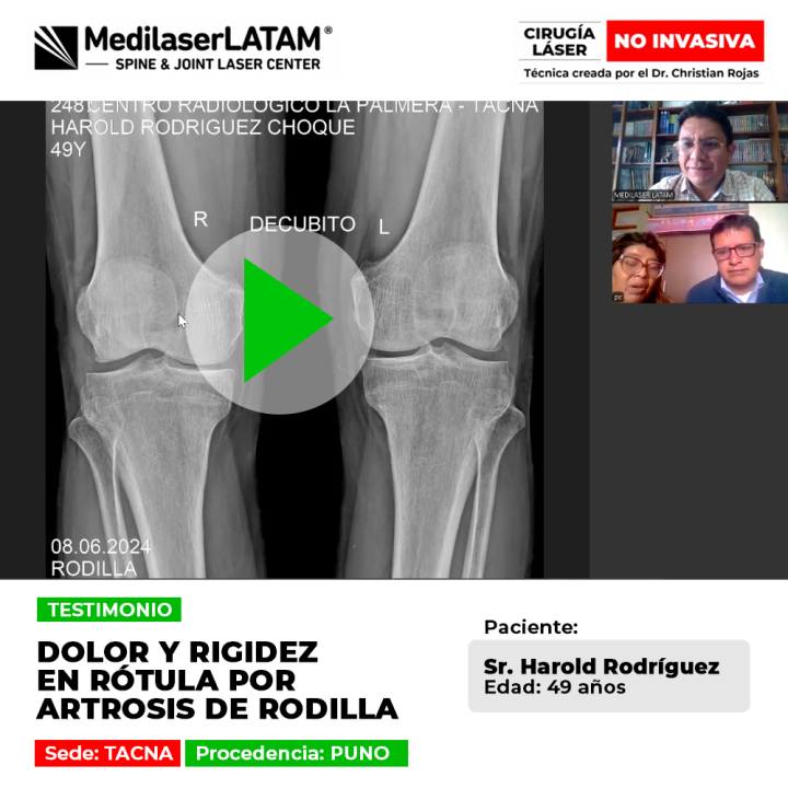 Harold Rodríguez superó el artrosis rótula rigidez y dolor. Vea el testimonio de este paciente de Puno que recuperó la movilidad de su rodilla con láser.