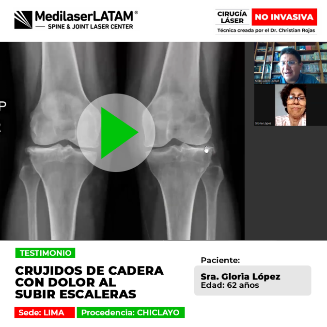 Crujidos cadera escaleras: Gloria López (Chiclayo) sufría dolor. Descubra cómo la cirugía láser eliminó el dolor articular y le devolvió la independencia.