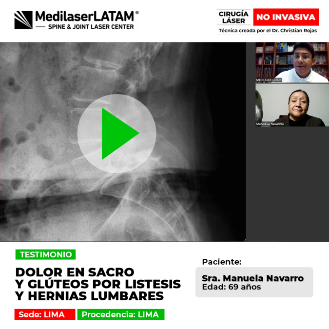 Listesis hernias lumbares: La Sra. Manuela Navarro (69) sufría dolor en sacro y glúteos. Conozca cómo el tratamiento láser de Medilaser LATAM la ayudó a sanar.