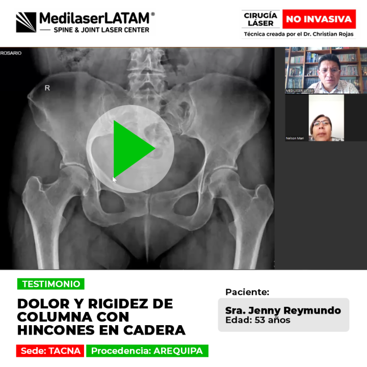 Rigidez columna cadera: Jenny Reymundo (53) superó el dolor y los hincones. Conozca cómo la cirugía láser frena el deterioro articular de la columna.