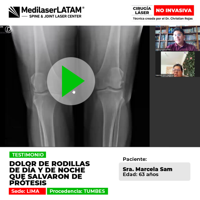 Dolor rodillas prótesis: Marcela Sam (Tumbes) sufría dolor 24/7. Vea cómo la cirugía láser no invasiva frenó el deterioro articular y le salvó de dos prótesis.