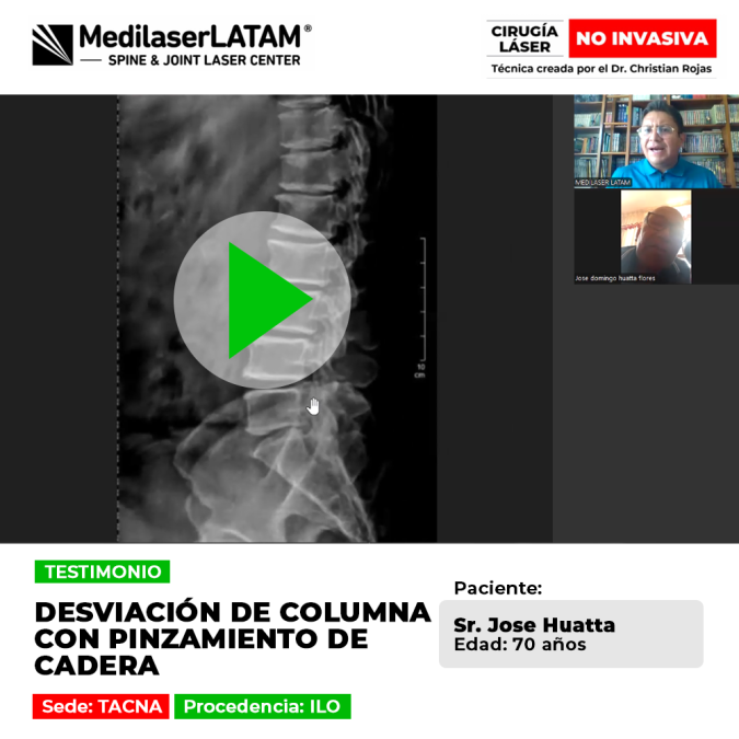 Desviación columna pinzamiento de cadera: Jose Huatta (70) venció el dolor y recuperó su postura con cirugía láser no invasiva. Vea su testimonio.