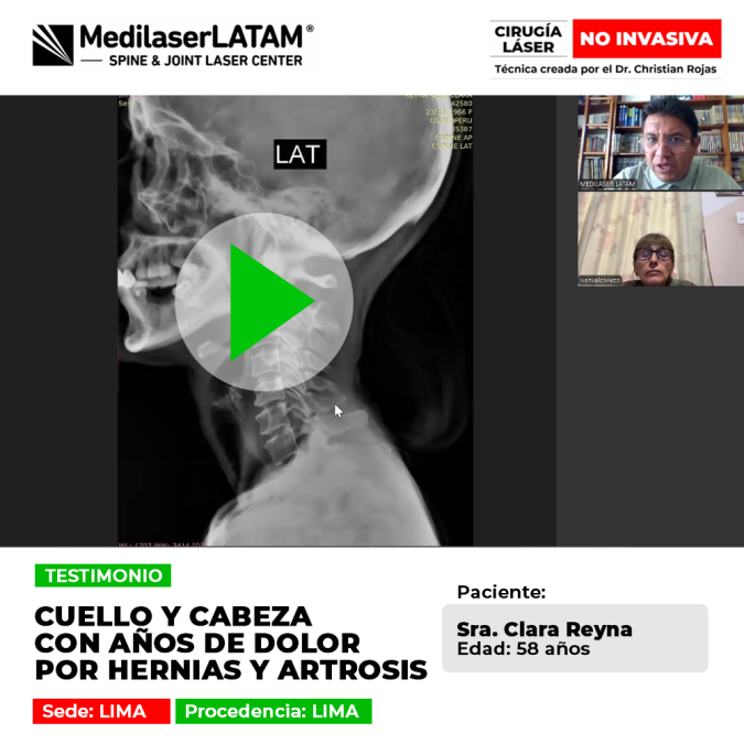 Vea este testimonio: Dolor Cuello Cabeza crónico en Clara Reyna (58). La cirugía láser cervical resolvió la raíz de sus migrañas y artrosis.