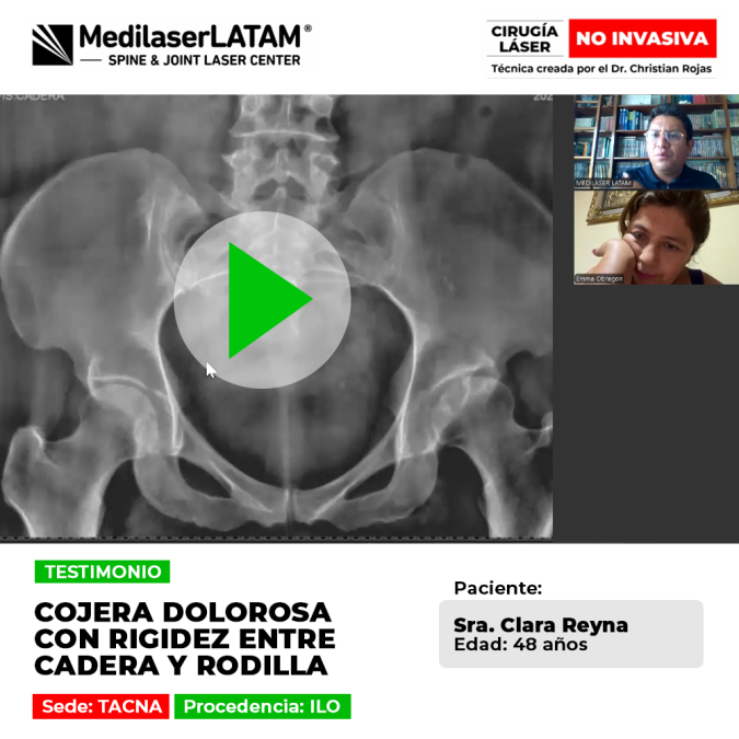 Testimonio: Cojera Rigidez Cadera en Norma Obregon (48). Conozca cómo la cirugía láser frena el deterioro articular y devuelve la movilidad a la cadera y rodilla.