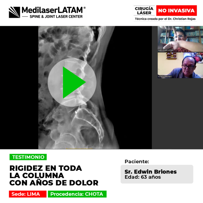 Testimonio: Rigidez Columna Dolor crónico en Edwin Briones (63). Vea cómo la cirugía láser no invasiva transformó su vida después de años de sufrimiento.