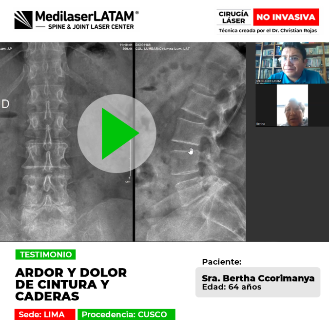 Testimonio: Dolor Cintura Caderas y ardor en Bertha Ccorimanya (64). Descubra cómo la cirugía láser eliminó el dolor articular de forma no invasiva.