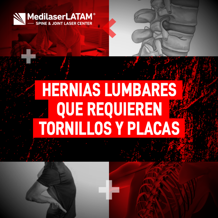 Hernias lumbar tornillos y placas: ¿Cuándo es realmente necesaria la cirugía con tornillos? El Dr. Rojas explica alternativas láser no invasivas.