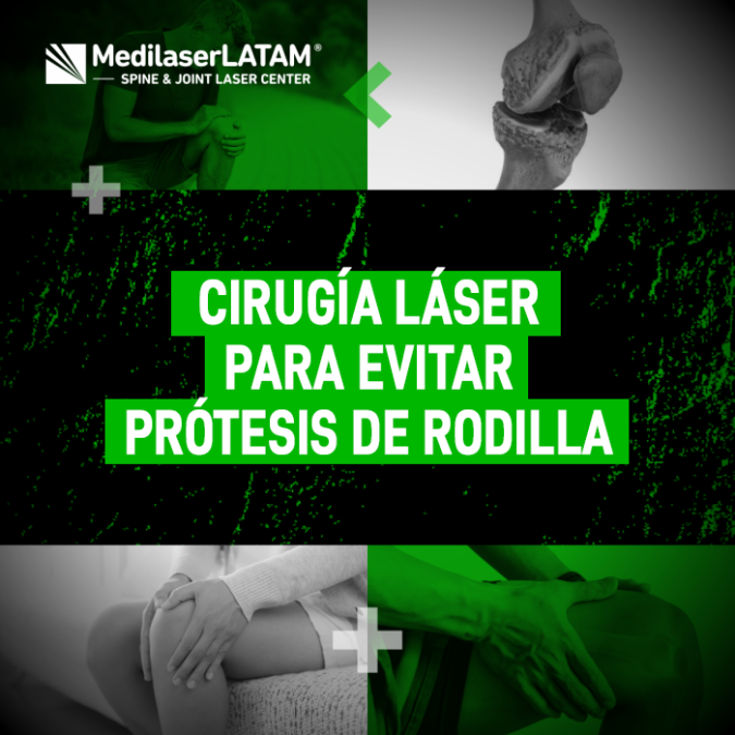 Cirugía láser prótesis: ¿Es posible evitar el reemplazo total de rodilla? Conoce la tecnología láser que salva tu articulación de la cirugía mayor.